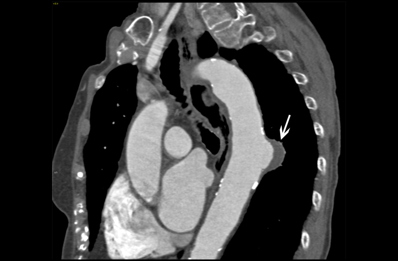 Mini Simposio: gli aneurismi dell’aorta